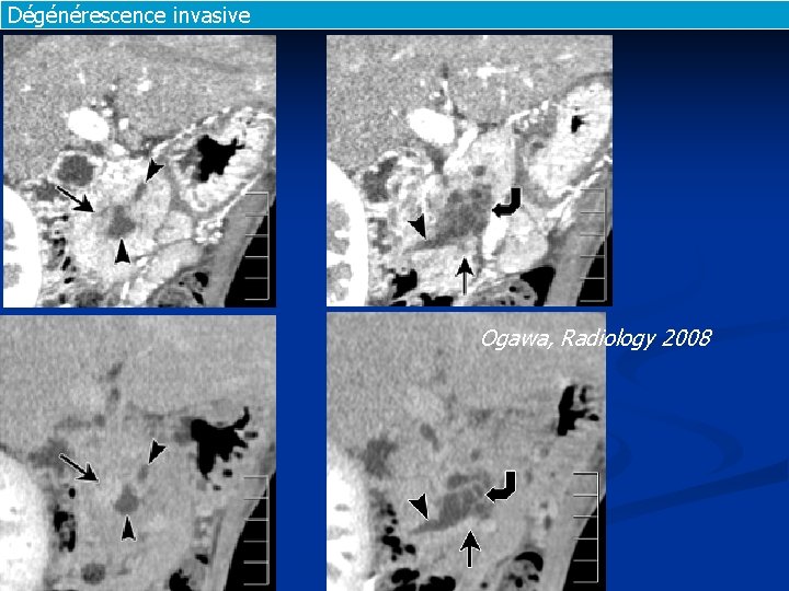 Dégénérescence invasive Ogawa, Radiology 2008 Dégénérescence invasive Ogawa, Radiology 2008