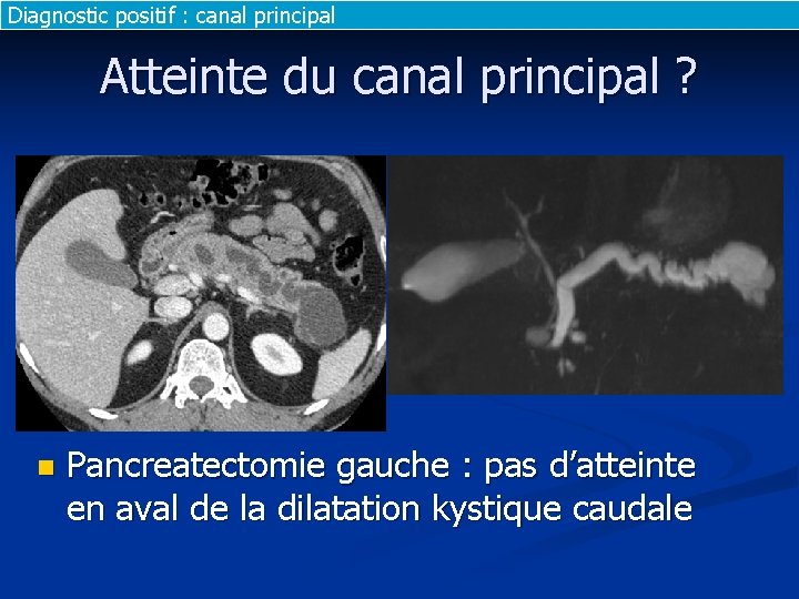 Diagnostic positif : canal principal Atteinte du canal principal ? n Pancreatectomie gauche :