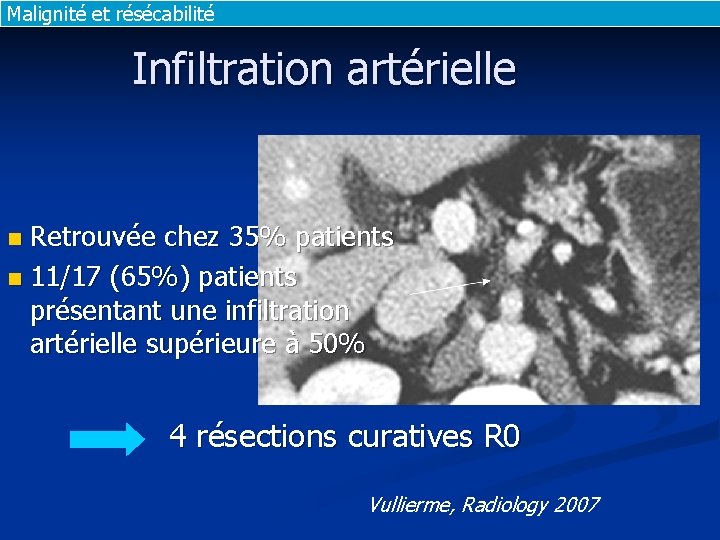 Malignité et résécabilité Infiltration artérielle Retrouvée chez 35% patients n 11/17 (65%) patients présentant Malignité et résécabilité Infiltration artérielle Retrouvée chez 35% patients n 11/17 (65%) patients présentant