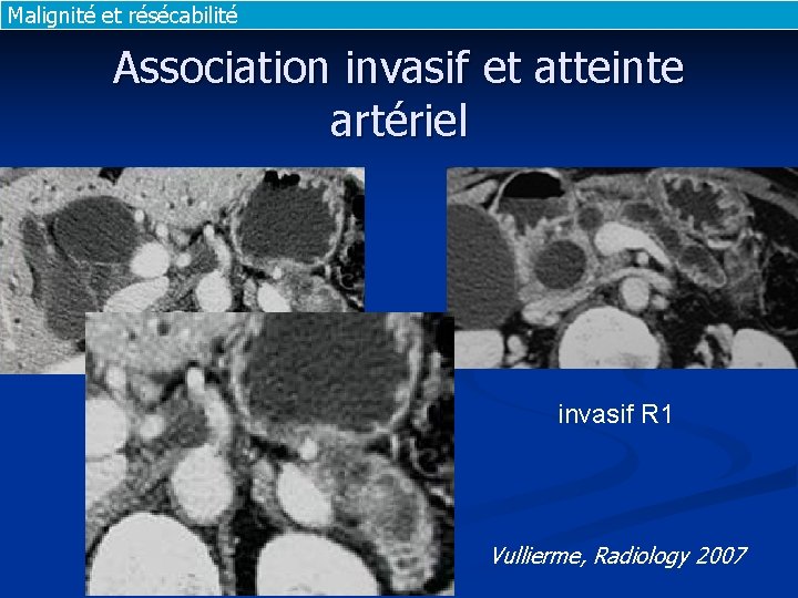 Malignité et résécabilité Association invasif et atteinte artériel invasif R 1 Vullierme, Radiology 2007