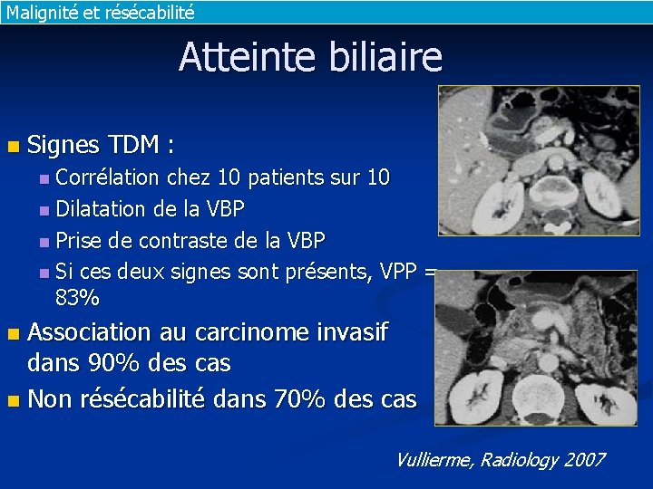 Malignité et résécabilité Atteinte biliaire n Signes TDM : n Corrélation chez 10 patients Malignité et résécabilité Atteinte biliaire n Signes TDM : n Corrélation chez 10 patients
