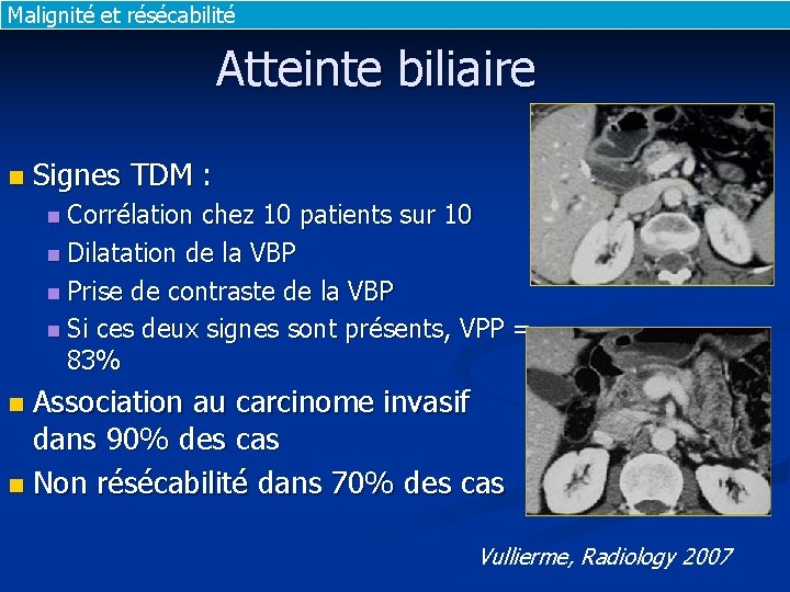 Malignité et résécabilité Atteinte biliaire n Signes TDM : n Corrélation chez 10 patients