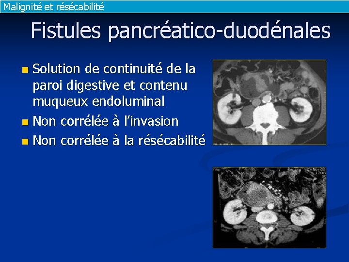 Malignité et résécabilité Fistules pancréatico-duodénales Solution de continuité de la paroi digestive et contenu Malignité et résécabilité Fistules pancréatico-duodénales Solution de continuité de la paroi digestive et contenu