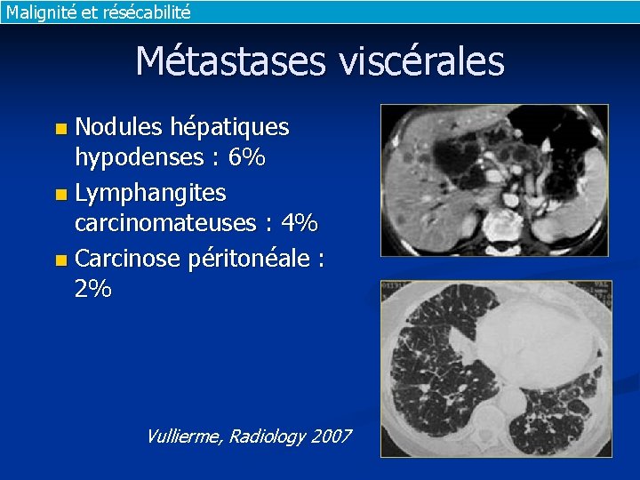 Malignité et résécabilité Métastases viscérales Nodules hépatiques hypodenses : 6% n Lymphangites carcinomateuses :