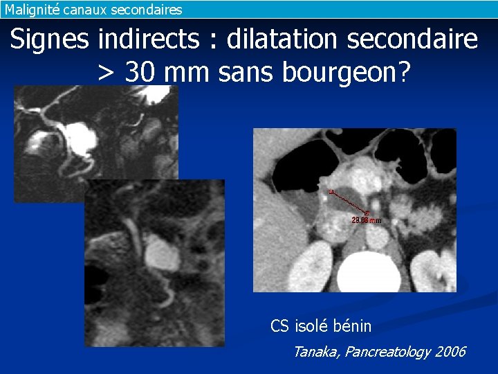 Malignité canaux secondaires Signes indirects : dilatation secondaire > 30 mm sans bourgeon? CS Malignité canaux secondaires Signes indirects : dilatation secondaire > 30 mm sans bourgeon? CS