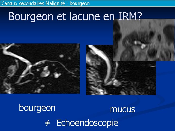 Canaux secondaires Malignité : bourgeon Bourgeon et lacune en IRM? bourgeon mucus ≠ Echoendoscopie Canaux secondaires Malignité : bourgeon Bourgeon et lacune en IRM? bourgeon mucus ≠ Echoendoscopie