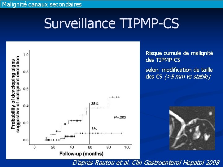 Malignité canaux secondaires Surveillance TIPMP-CS Risque cumulé de malignité des TIPMP-CS selon modification de Malignité canaux secondaires Surveillance TIPMP-CS Risque cumulé de malignité des TIPMP-CS selon modification de