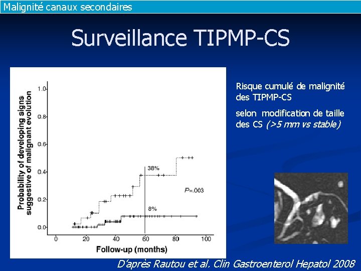 Malignité canaux secondaires Surveillance TIPMP-CS Risque cumulé de malignité des TIPMP-CS selon modification de