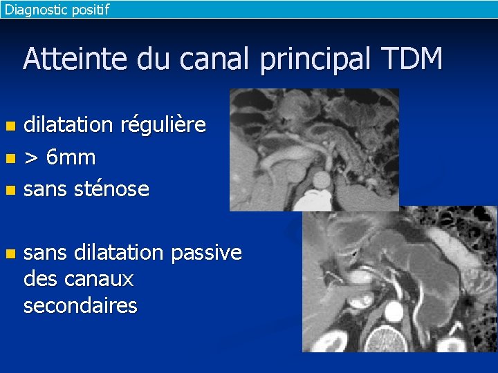 Diagnostic positif Atteinte du canal principal TDM dilatation régulière n > 6 mm n