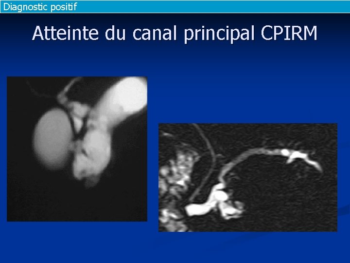 Diagnostic positif Atteinte du canal principal CPIRM 