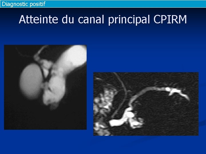 Diagnostic positif Atteinte du canal principal CPIRM Diagnostic positif Atteinte du canal principal CPIRM