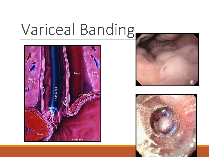 Variceal Banding 