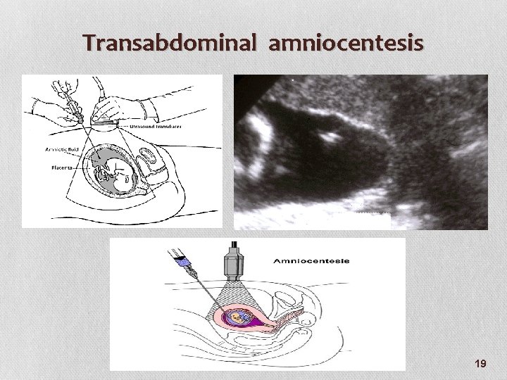 Transabdominal amniocentesis 19 