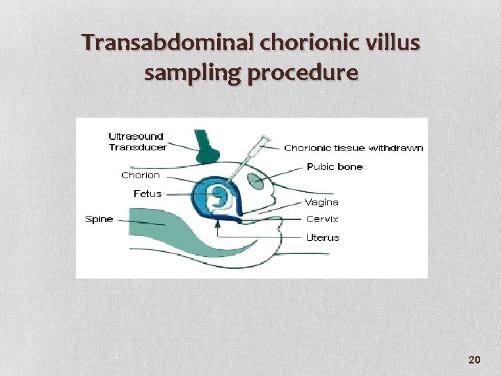 Transabdominal chorionic villus sampling procedure 20 