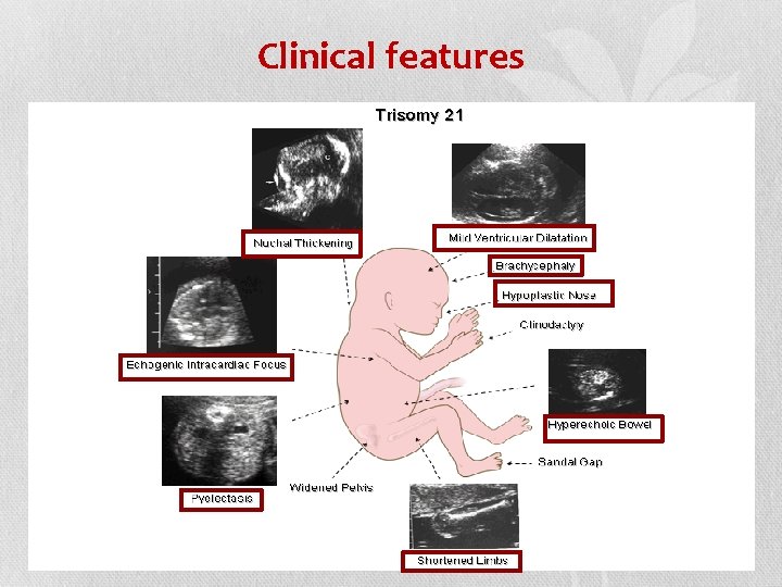 Clinical features 25 