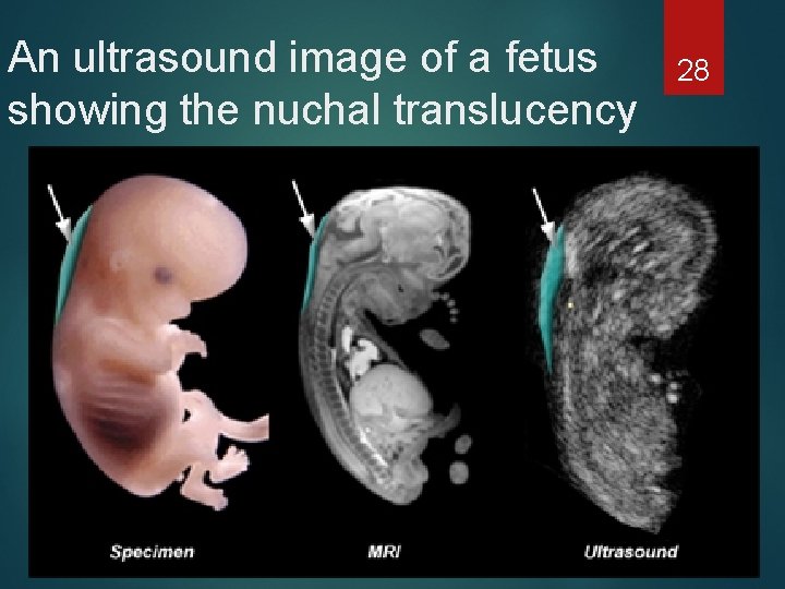 An ultrasound image of a fetus showing the nuchal translucency 28 