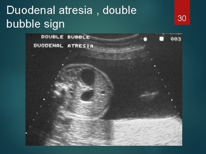 Duodenal atresia , double bubble sign 30 