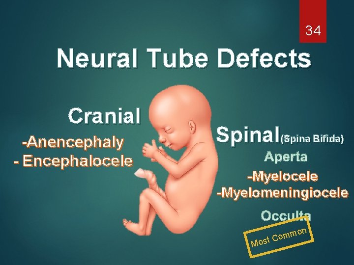 34 Neural Tube Defects Cranial -Anencephaly - Encephalocele Spinal(Spina Bifida) -Myelocele -Myelomeningiocele on Mo