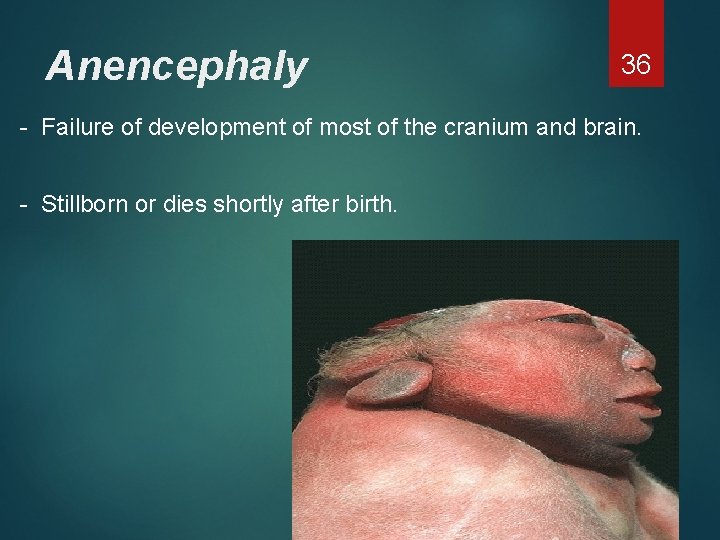 Anencephaly 36 - Failure of development of most of the cranium and brain. -