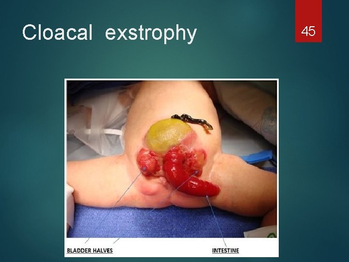 Cloacal exstrophy 45 