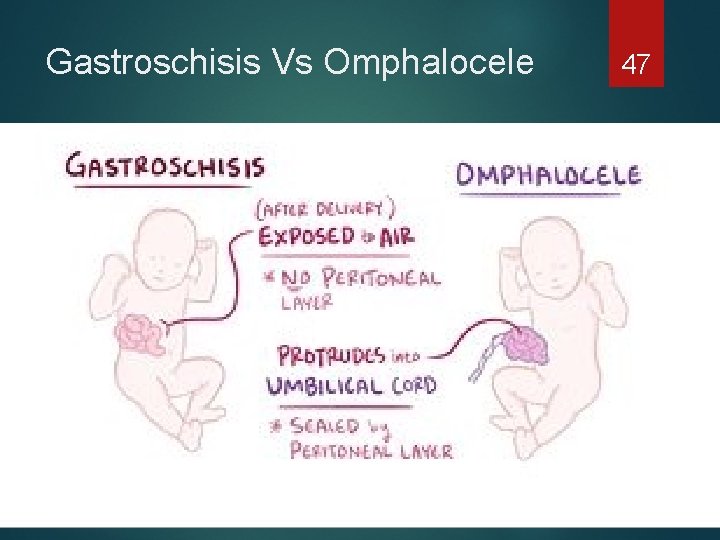 Gastroschisis Vs Omphalocele 47 