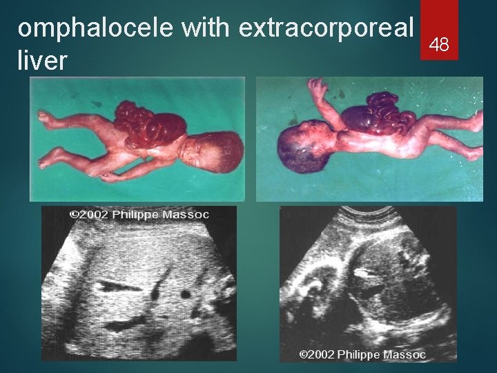 omphalocele with extracorporeal liver 48 
