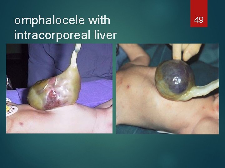 omphalocele with intracorporeal liver 49 