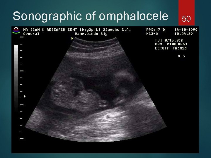 Sonographic of omphalocele 50 