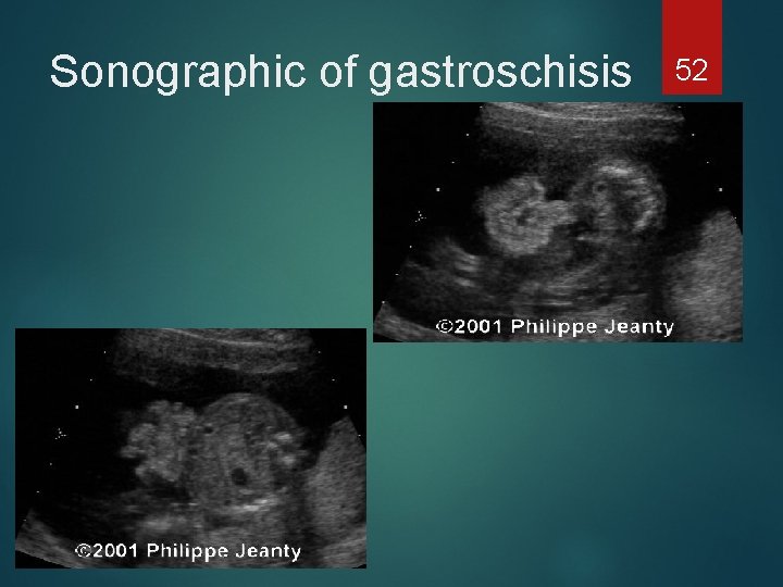 Sonographic of gastroschisis 52 