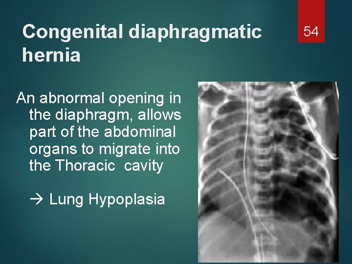 Congenital diaphragmatic hernia An abnormal opening in the diaphragm, allows part of the abdominal