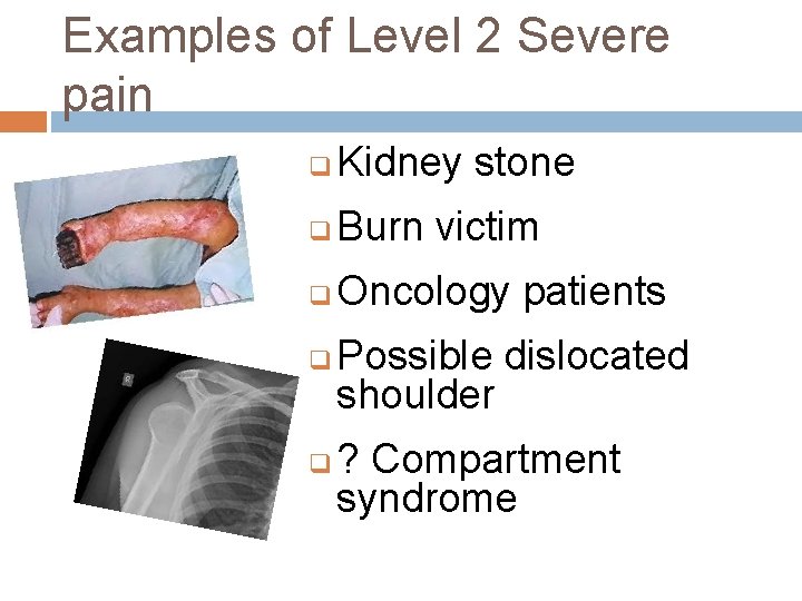 Examples of Level 2 Severe pain q Kidney stone q Burn victim q Oncology