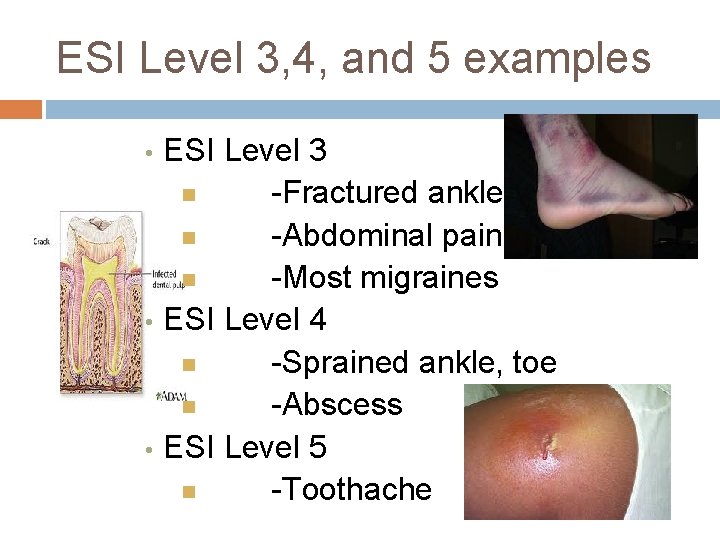 ESI Level 3, 4, and 5 examples ESI Level 3 -Fractured ankle -Abdominal pain