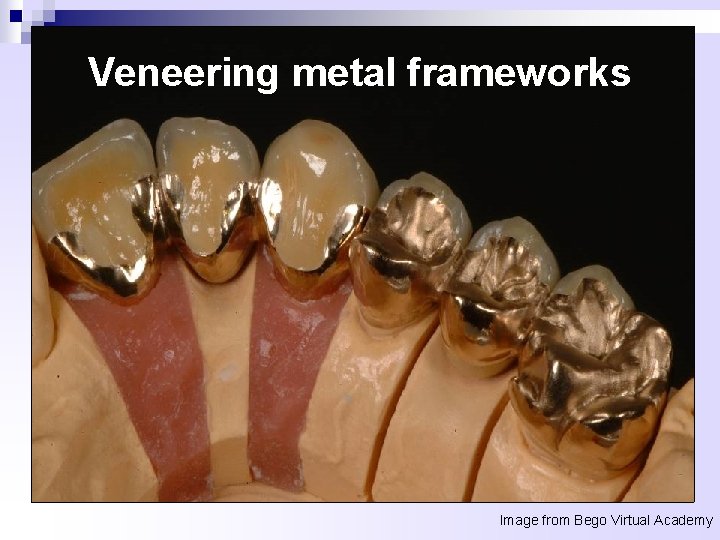 Veneering metal frameworks Image from Bego Virtual Academy 