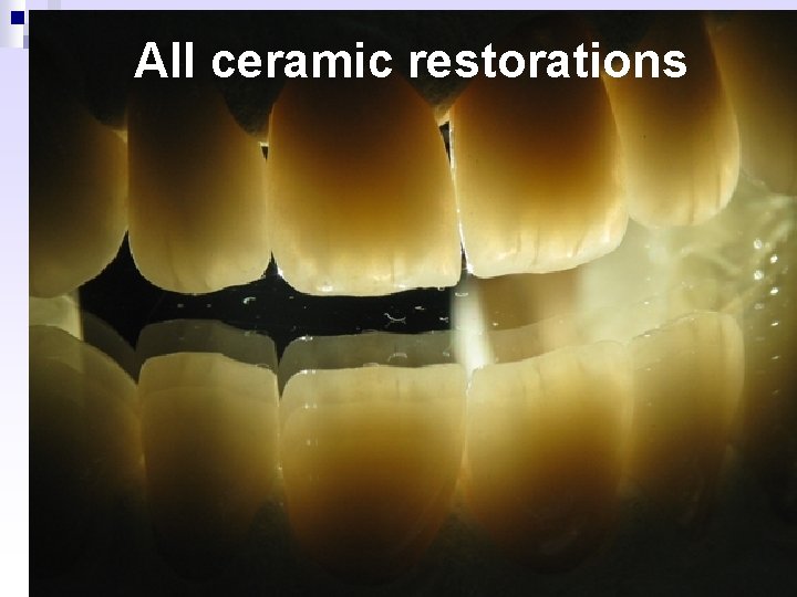 All ceramic restorations 