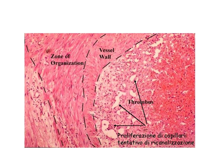 Proliferazione di capillari: tentativo di ricanalizzazione 