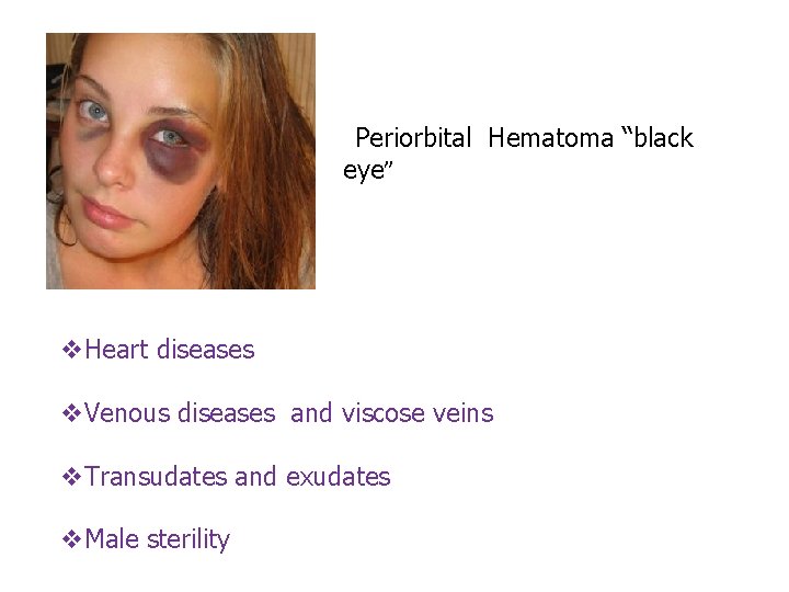  Periorbital Hematoma “black eye” v. Heart diseases v. Venous diseases and viscose veins