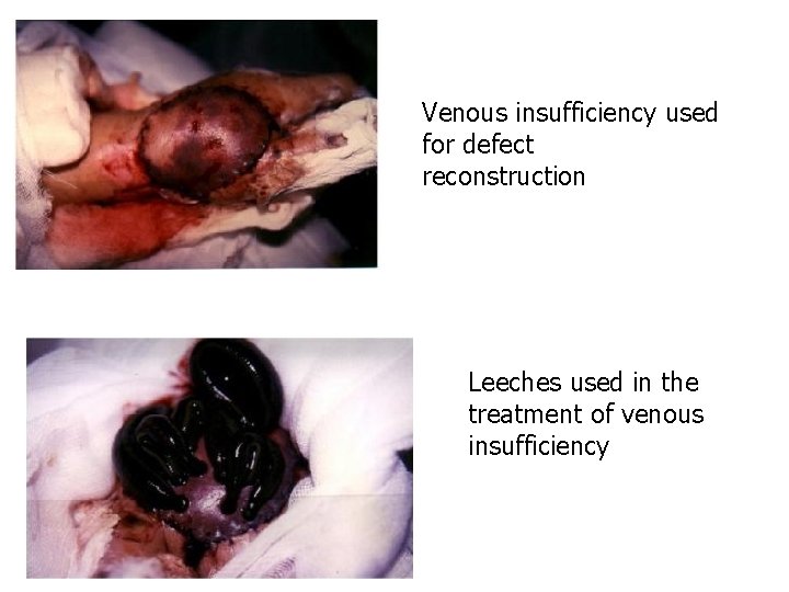 Venous insufficiency used for defect reconstruction Leeches used in the treatment of venous insufficiency