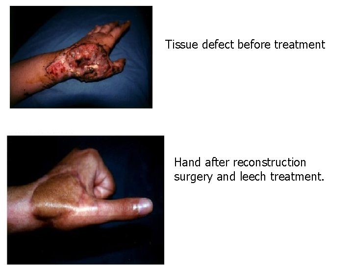 Tissue defect before treatment Hand after reconstruction surgery and leech treatment. 