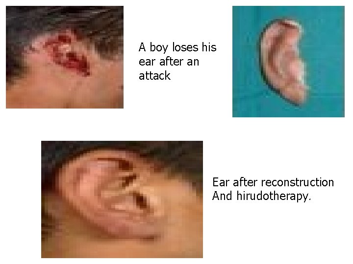 A boy loses his ear after an attack Ear after reconstruction And hirudotherapy. 