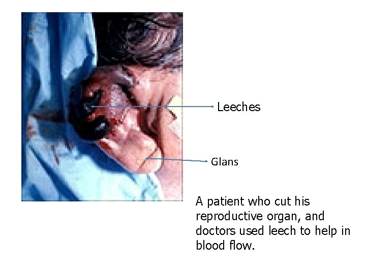 Leeches Glans A patient who cut his reproductive organ, and doctors used leech to