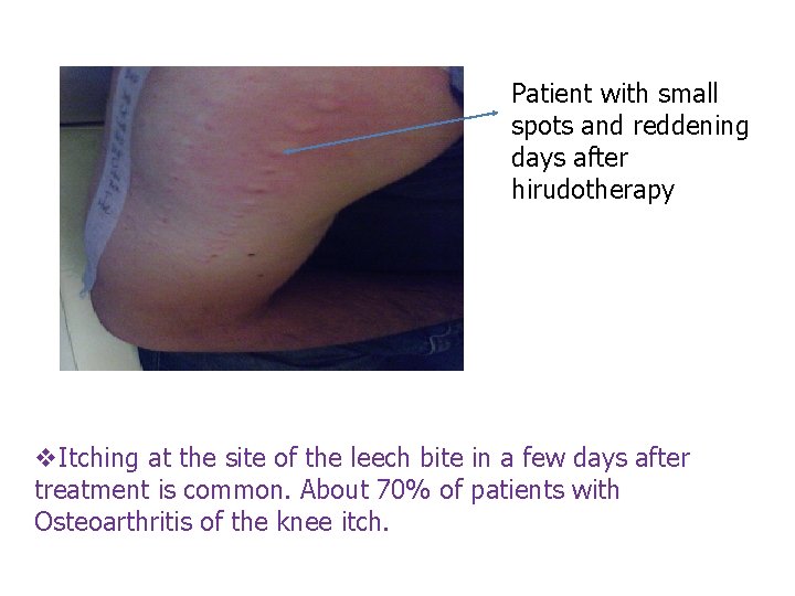 Patient with small spots and reddening days after hirudotherapy v. Itching at the site