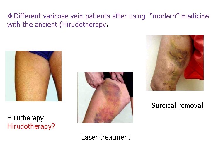 v. Different varicose vein patients after using “modern” medicine with the ancient (Hirudotherapy) Surgical