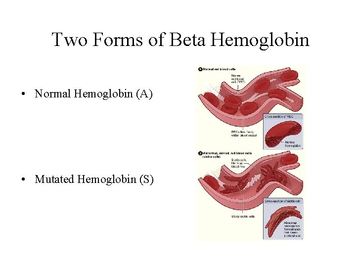  Two Forms of Beta Hemoglobin • Normal Hemoglobin (A) • Mutated Hemoglobin (S)