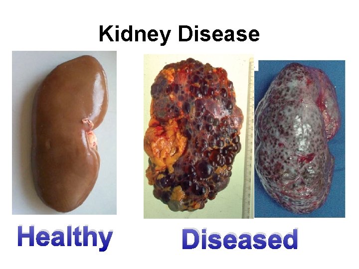 Kidney Disease Healthy Diseased 