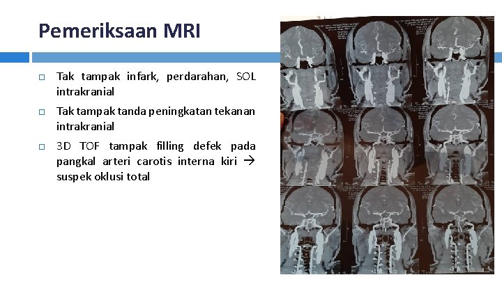 Pemeriksaan MRI Tak tampak infark, perdarahan, SOL intrakranial Tak tampak tanda peningkatan tekanan intrakranial