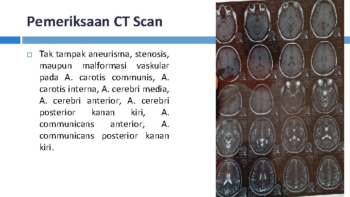 Pemeriksaan CT Scan Tak tampak aneurisma, stenosis, maupun malformasi vaskular pada A. carotis communis,