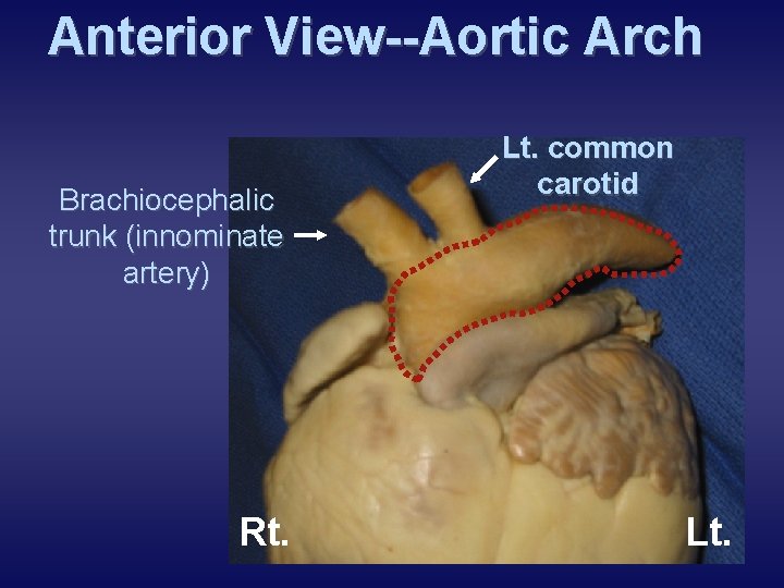 Anterior View--Aortic Arch Brachiocephalic trunk (innominate artery) Rt. Lt. common carotid Lt. 