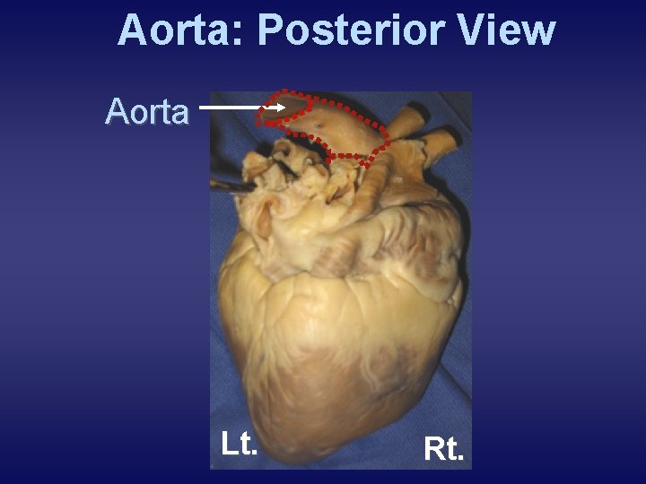 Aorta: Posterior View Aorta Lt. Rt. 