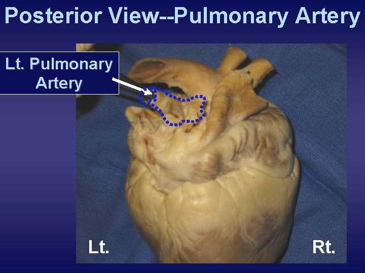 Posterior View--Pulmonary Artery Lt. Rt. 