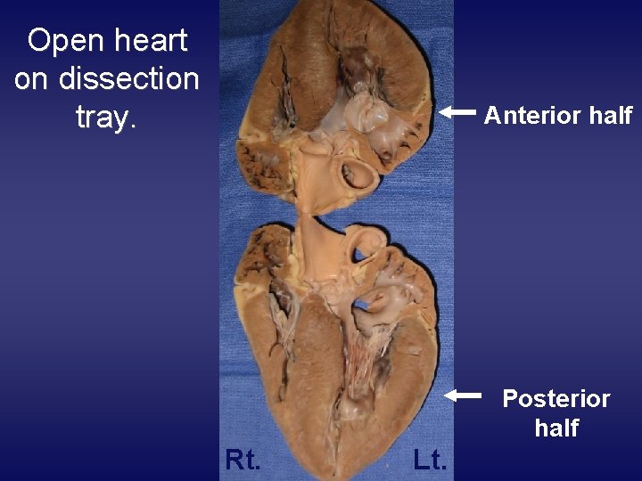 Open heart on dissection tray. Anterior half Posterior half Rt. Lt. 